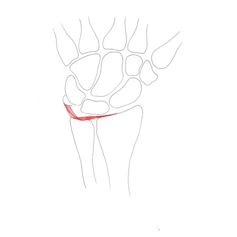 Lesioni del complesso della fibrocartilagine triangolare